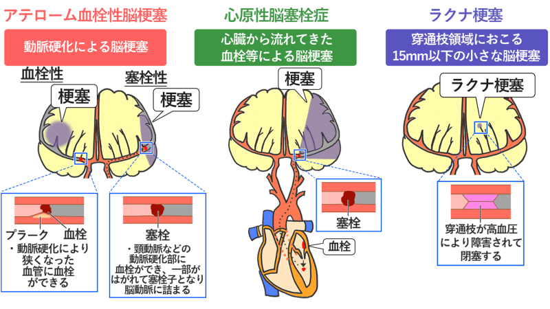 血栓性脳卒中にはどのような種類がありますか?