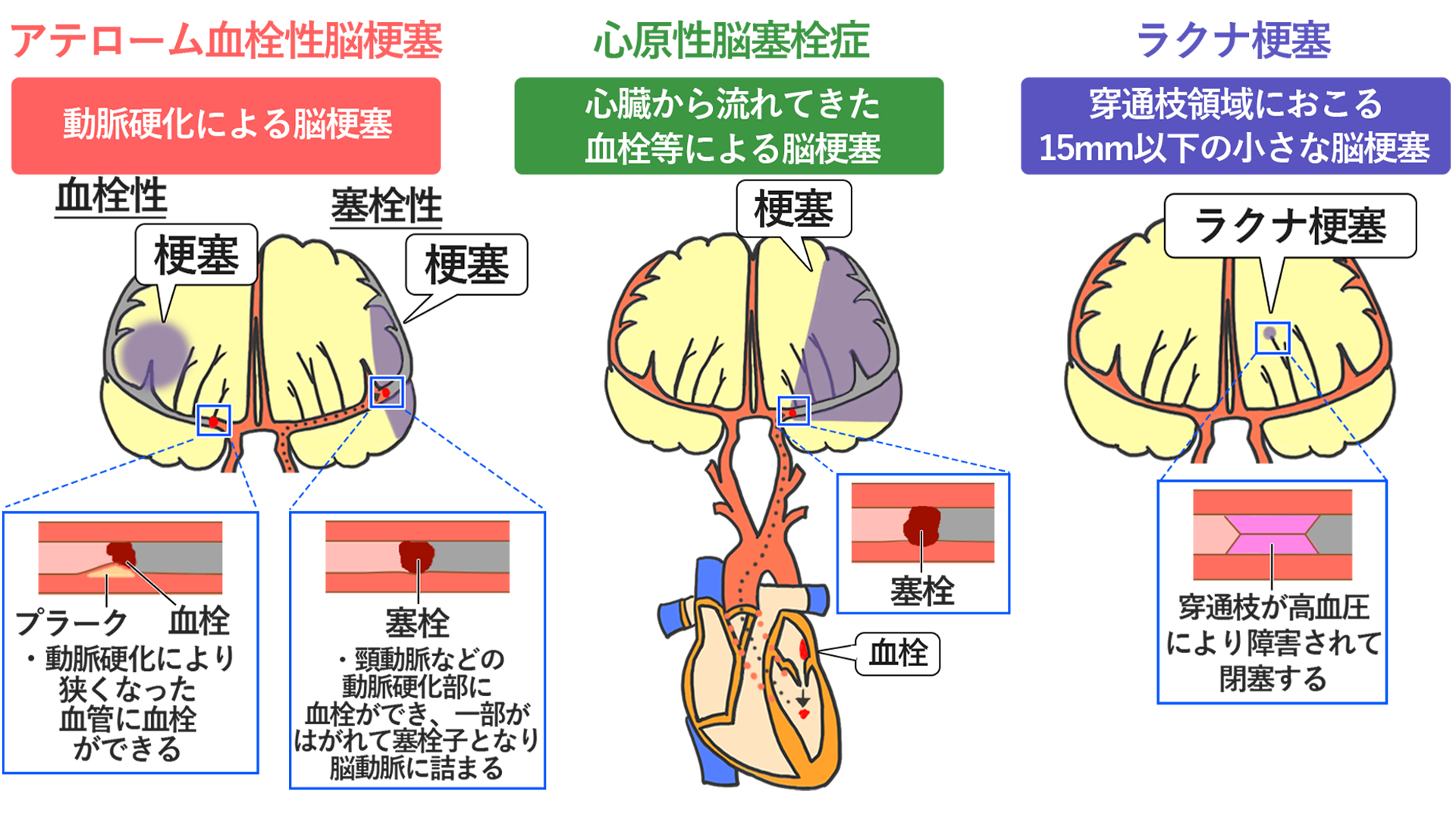 脳梗塞の原因とは 症状や前兆 予防方法から治療の流れまで全て紹介 サービス付き高齢者向け住宅の学研ココファン