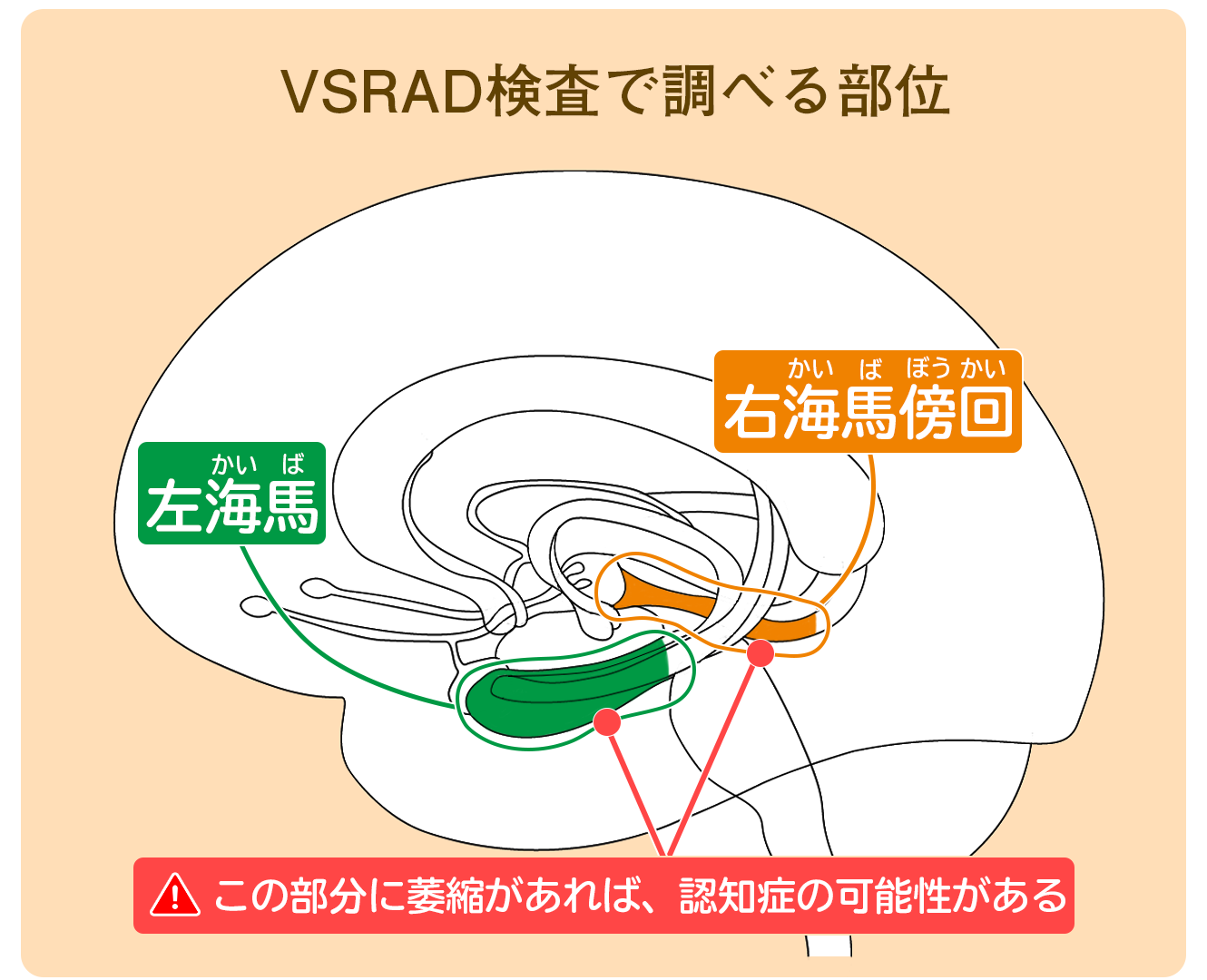 医師監修 認知症検査 Vsrad ブイエスラド とは 特徴や評価方法を解説 サービス付き高齢者向け住宅の学研ココファン