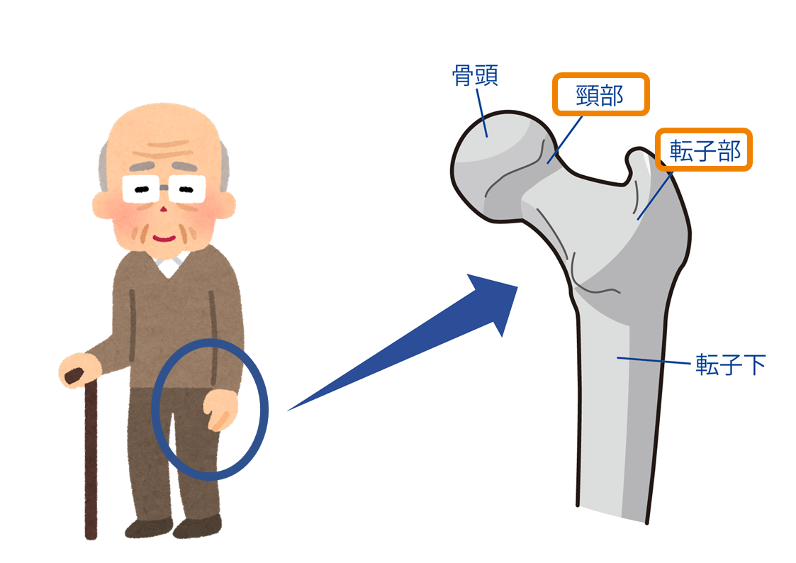 医師監修 大腿骨頸部骨折とは 症状や治療の方法 大腿骨転子部骨折との違いまで解説 サービス付き高齢者向け住宅の学研ココファン