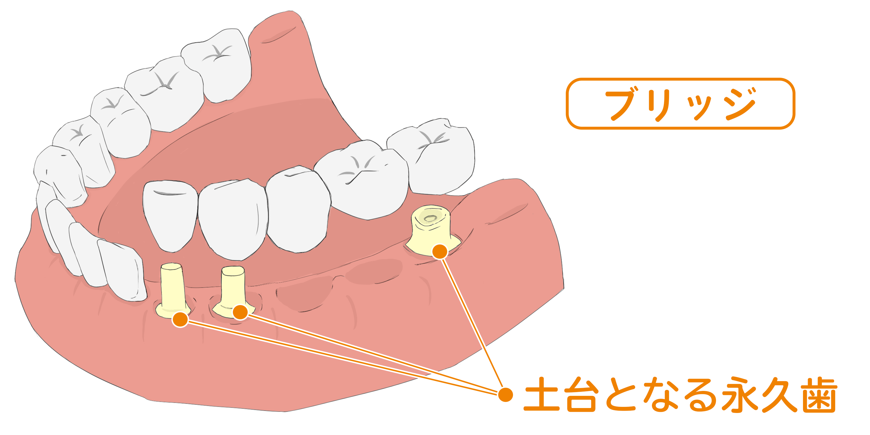 義歯とは 入れ歯の種類やそれぞれの特徴 費用まで全て解説 サービス付き高齢者向け住宅の学研ココファン 義歯とは 入れ歯の種類やそれぞれの特徴 費用まで全て解説 サービス付き高齢者向け住宅の学研ココファン