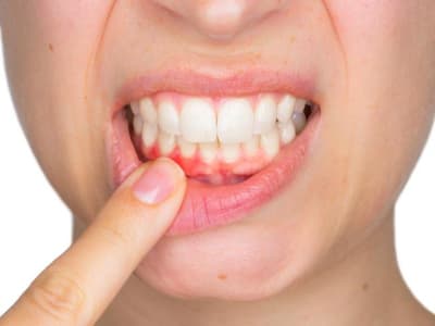 Bahan Alami, Inilah Pertologan Pertama pada Gusi Bengkak Versi SehatQ