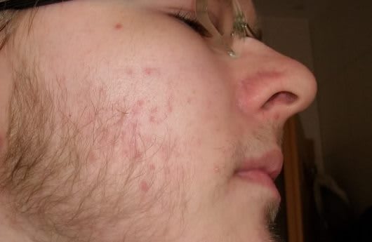Beard and Acne