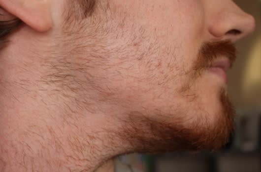 Dry Skin