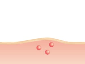 Verlichting van jeuk en zwelling