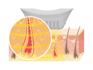 IPL-Grafik: Lichtimpulse dringen in die Haut ein und leiten Wärme gezielt zu den Haarwurzeln.