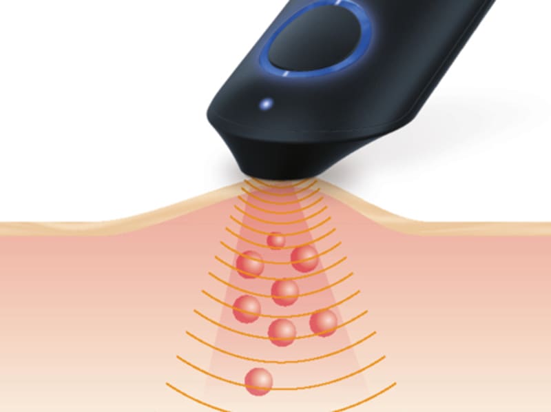Precise application of heat of the stitch healer