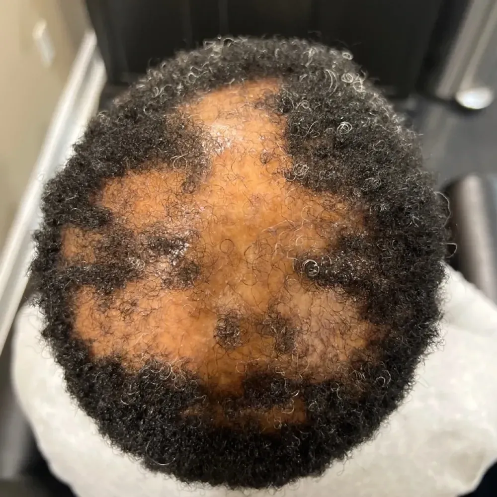 Tenderness Settled, Shedding Slowed before treatment