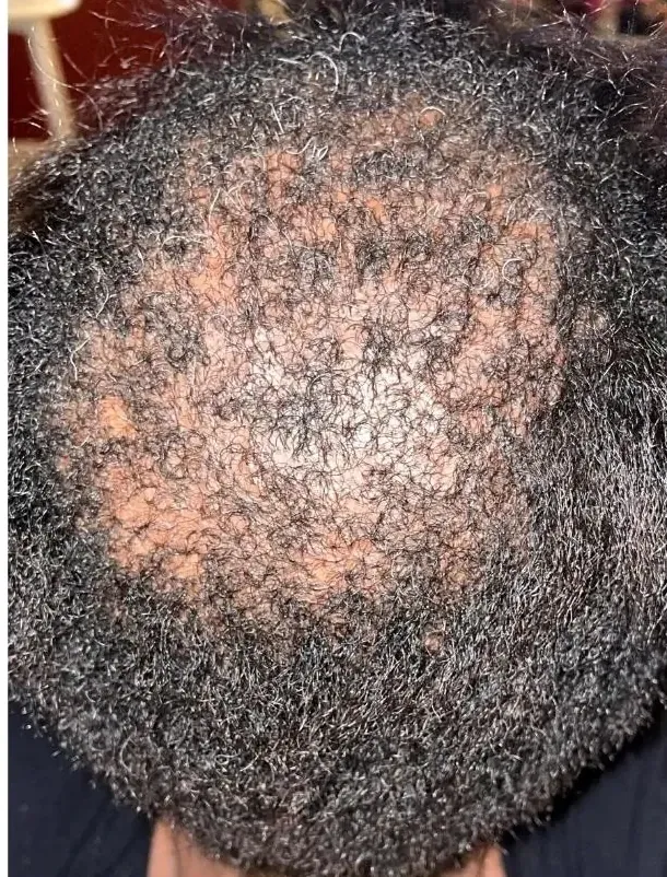 Early CCCA Held In Place before treatment