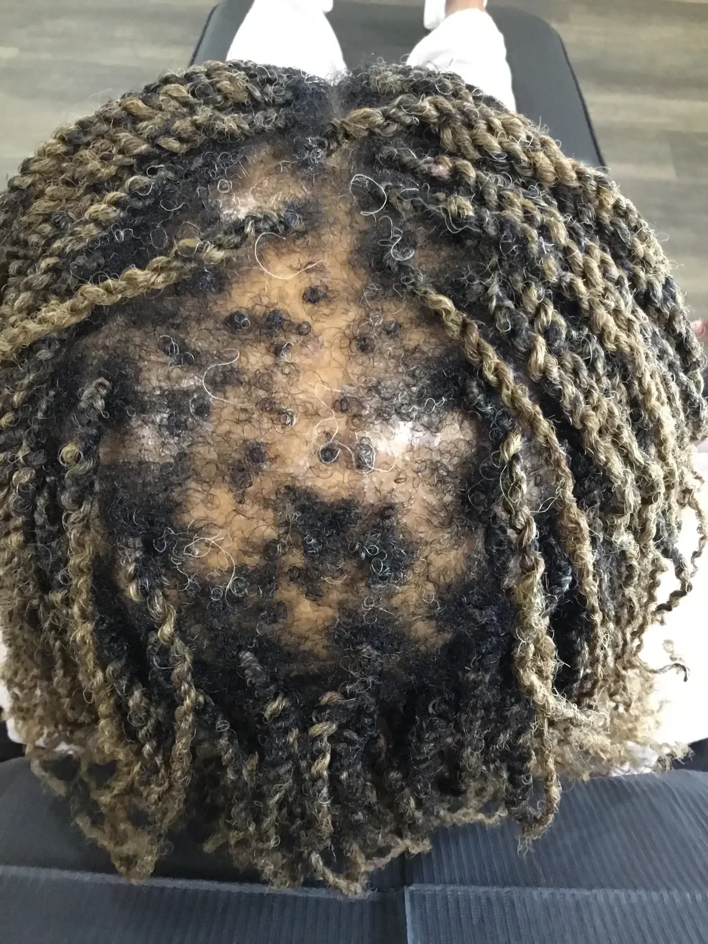 Tenderness Settled, Shedding Slowed after treatment