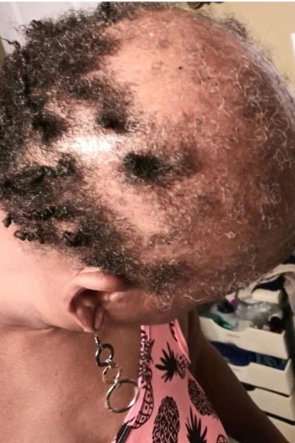 Filling In Around The Scarred Area during treatment