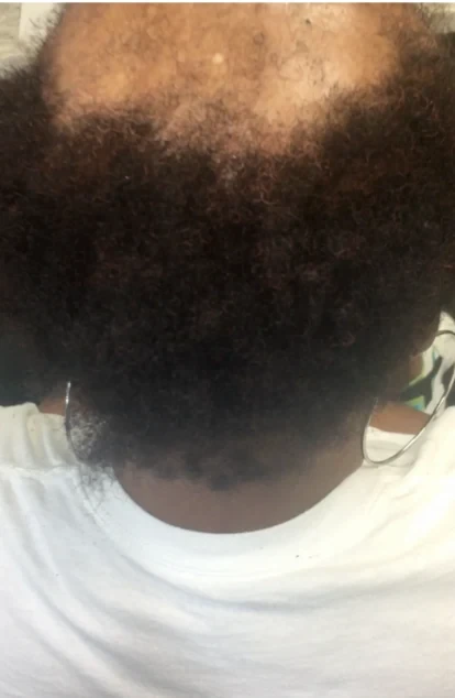 Filling In Around The Scarred Area after treatment