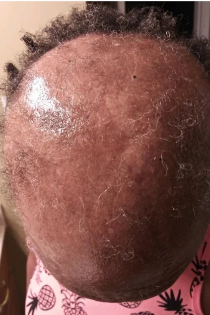 Filling In Around The Scarred Area before treatment