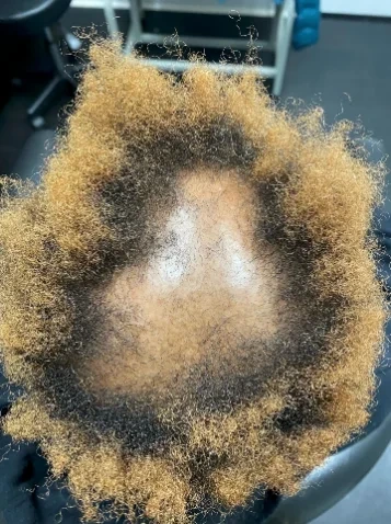 CCCA before trichology care at Nina Ross Atlanta