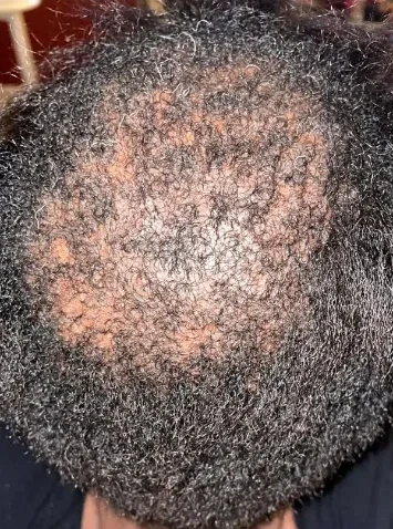 Top-down view of early scarring alopecia at a client's crown before treatment