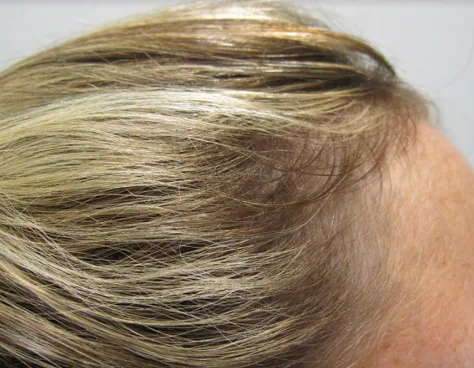 The same part and crown after 32 weeks of treatment