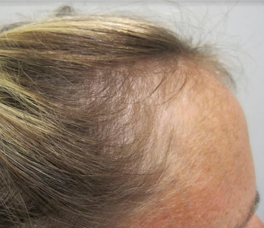 Female pattern hair loss at the part and crown before treatment