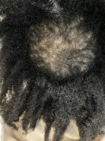 Top-down view of thyroid-related thinning along a client's part before treatment began