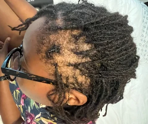 Back of a client's head showing alopecia areata patches before treatment began