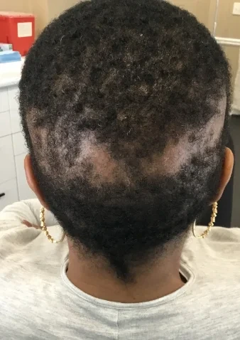 Telogen effluvium thinning at the part before treatment