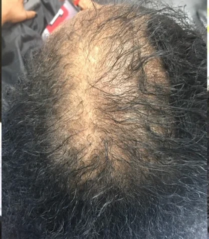 Top-down view of CCCA thinning at the crown before treatment began