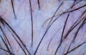 A client's scalp magnified 200 times during a trichology scalp analysis in Atlanta