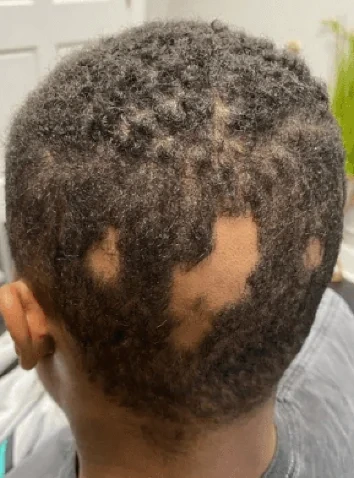 Back view of telogen effluvium shedding with bare patches before treatment began