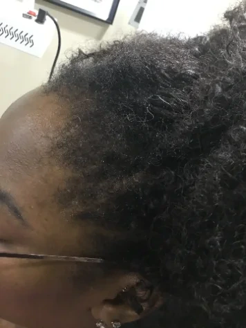 The same hairline after 31 weeks of treatment
