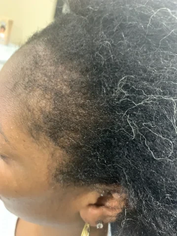 Traction alopecia thinning along a client's hairline photographed before treatment began