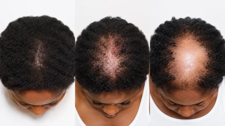 Bathroom counter crowded with hair products tried before getting a 200x scalp reading