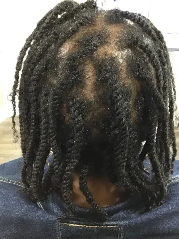 Traction alopecia after trichology care at Nina Ross Atlanta