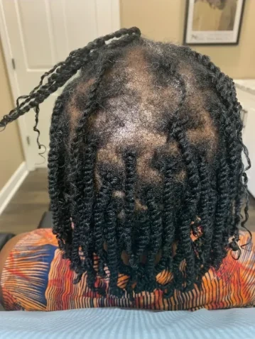 Traction alopecia before trichology care at Nina Ross Atlanta