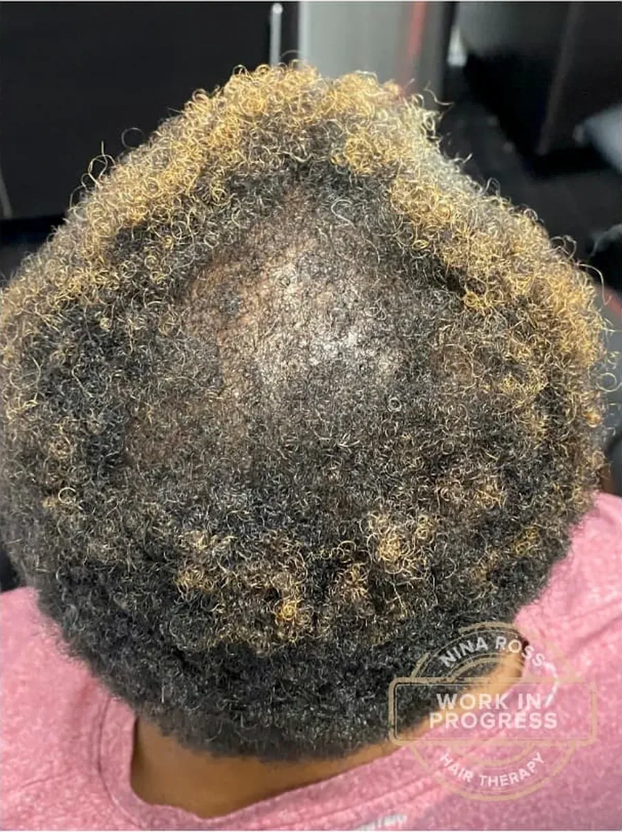 Crown Coverage Returning after treatment