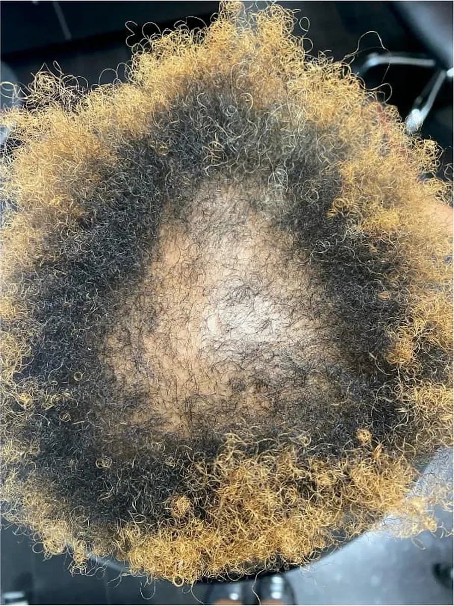 Crown Coverage Returning during treatment