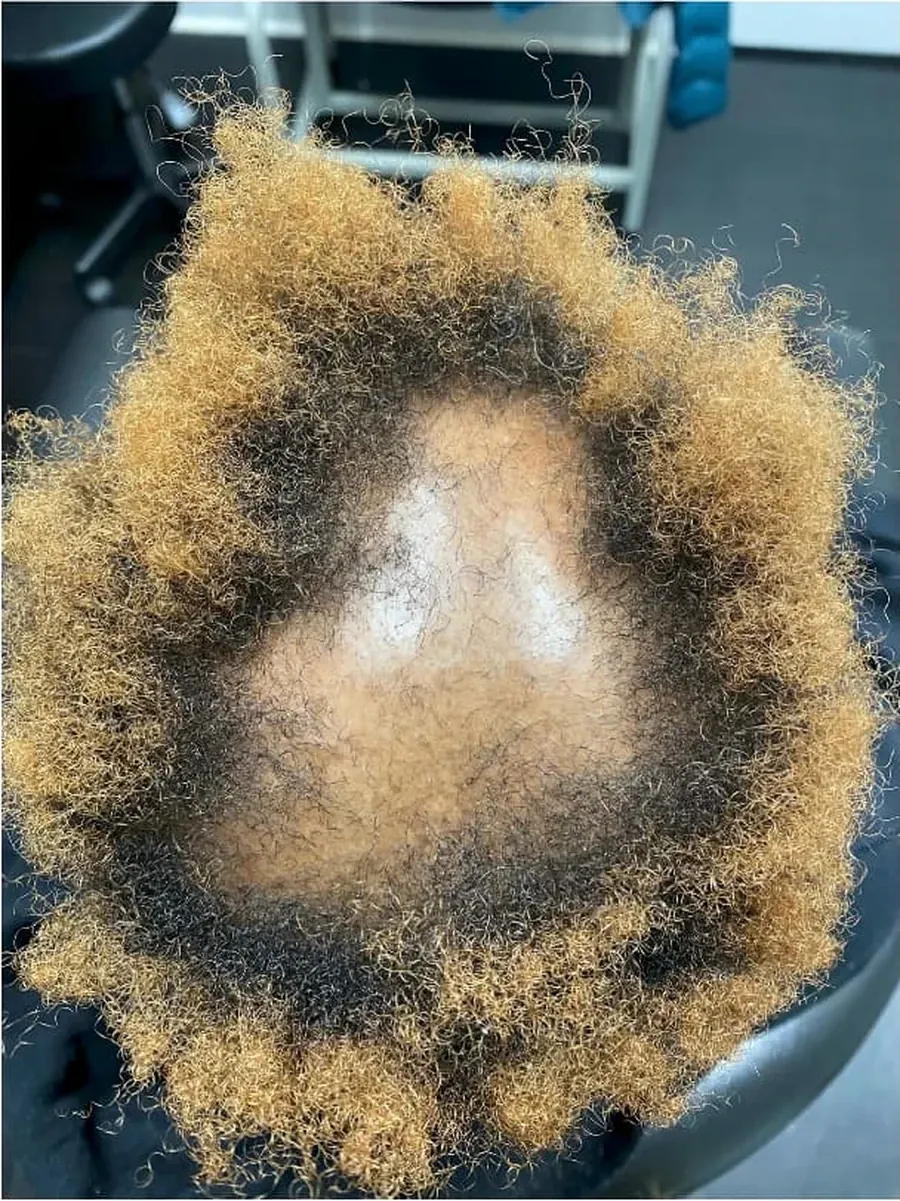 Crown Coverage Returning before treatment