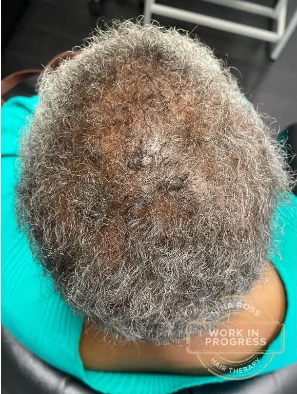 Shedding Slowed, Density Returned after treatment