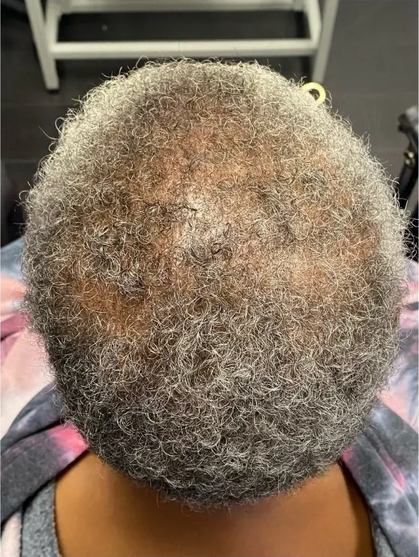 Shedding Slowed, Density Returned during treatment