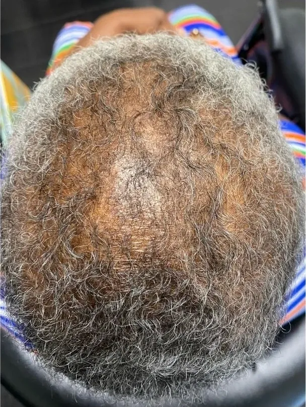 Shedding Slowed, Density Returned before treatment