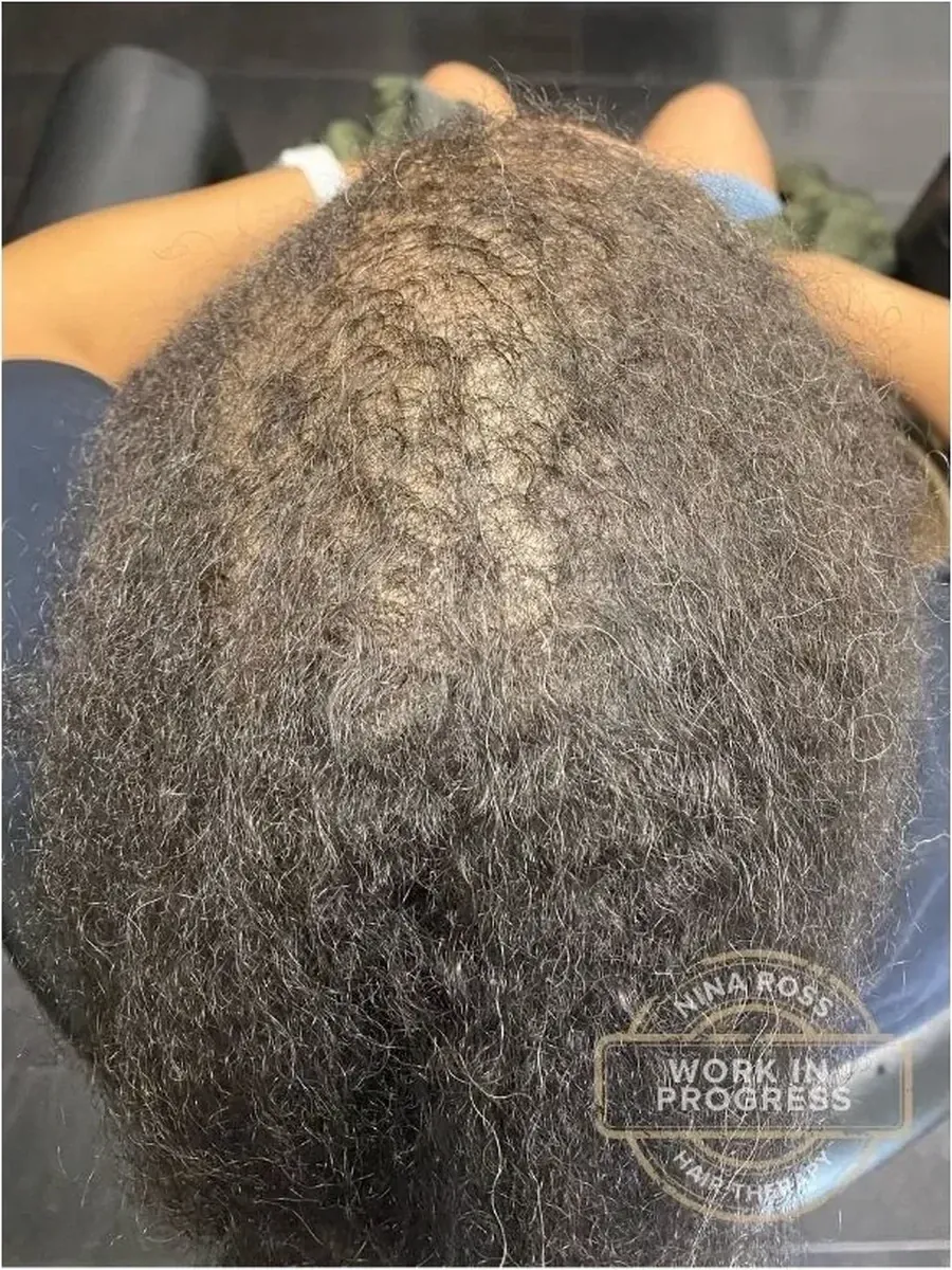 Edges Filling Back In after treatment