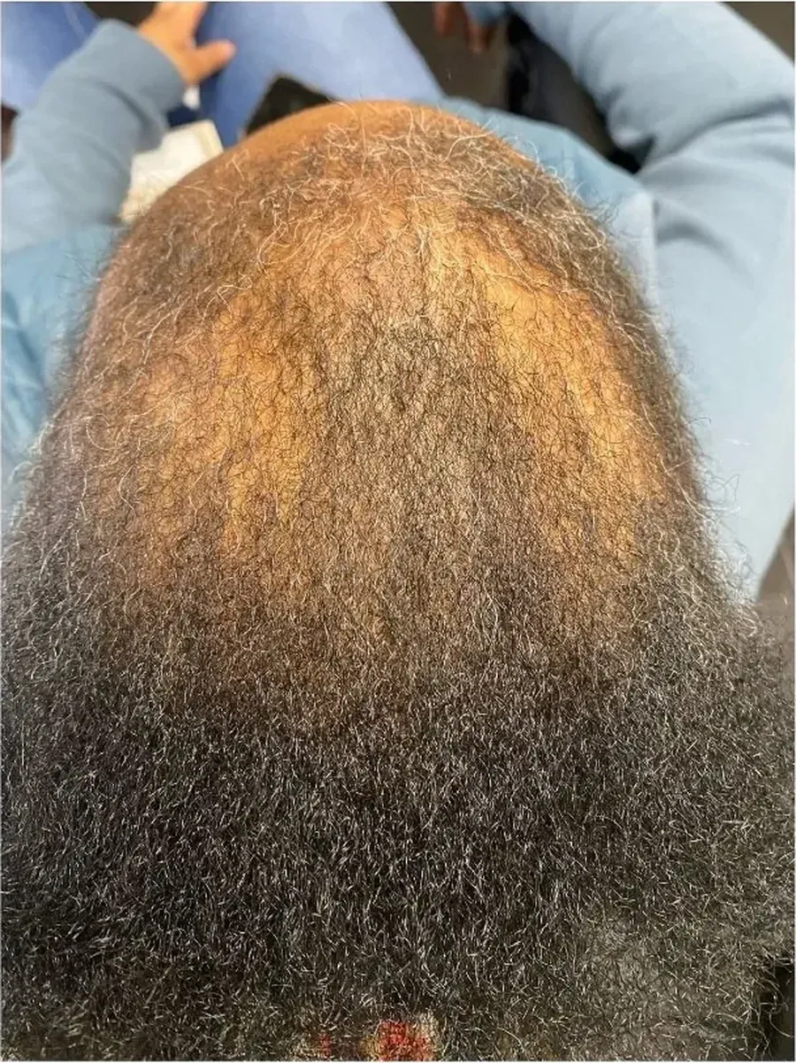 Edges Filling Back In during treatment