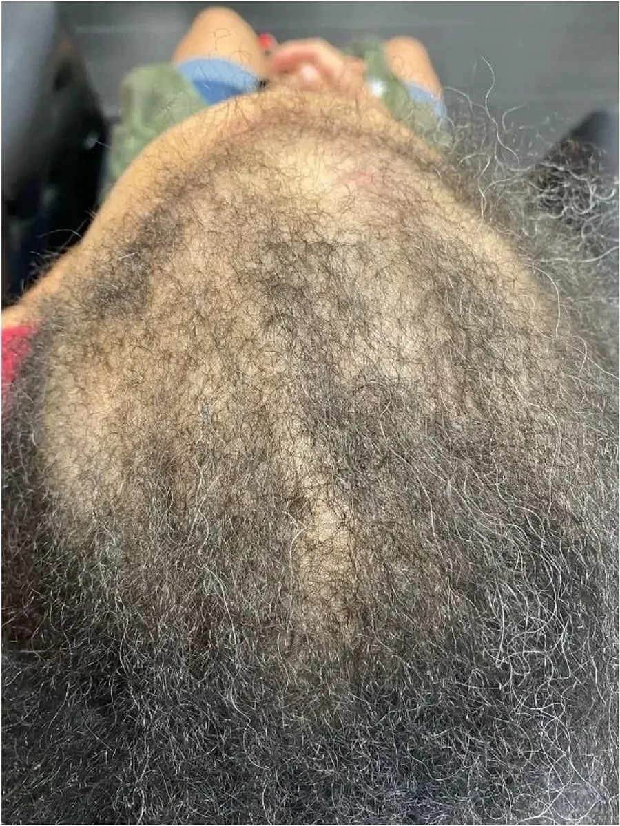 Edges Filling Back In before treatment