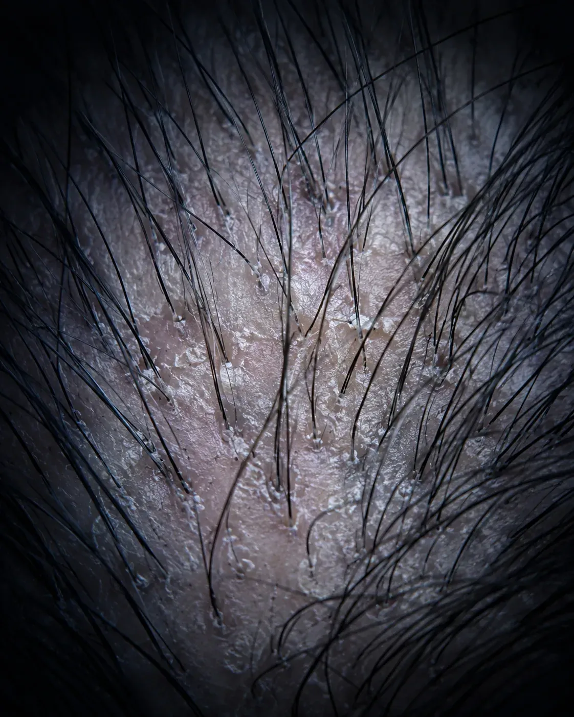 200x magnified view of the scalp showing hair follicles and surrounding skin