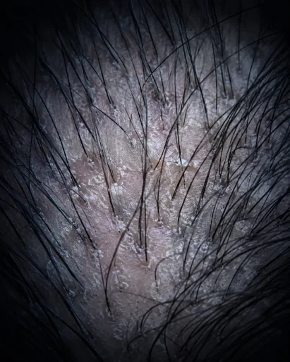 Healthy hair follicles seen at 200x magnification during a Nina Ross Atlanta scalp analysis