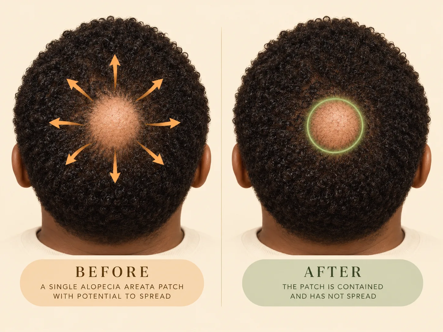 Comparison illustration of a single alopecia areata patch shown with outward arrows and with its border contained