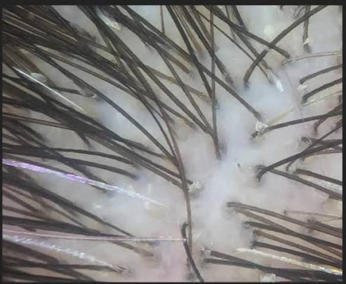 200x trichoscopy view of a scalp showing diffuse, even thinning across the area