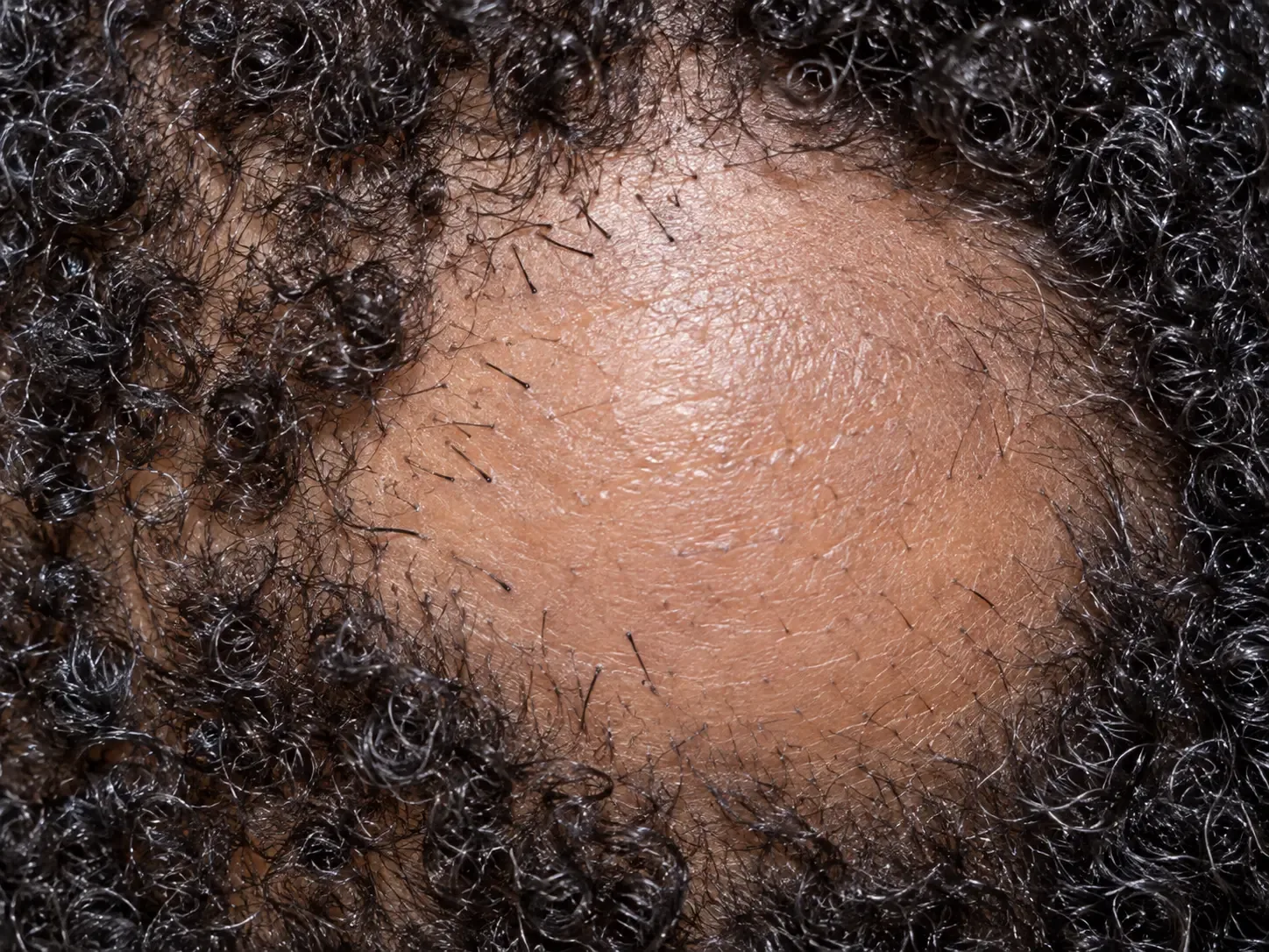 Short tapered exclamation mark hairs along the border of an active alopecia areata patch