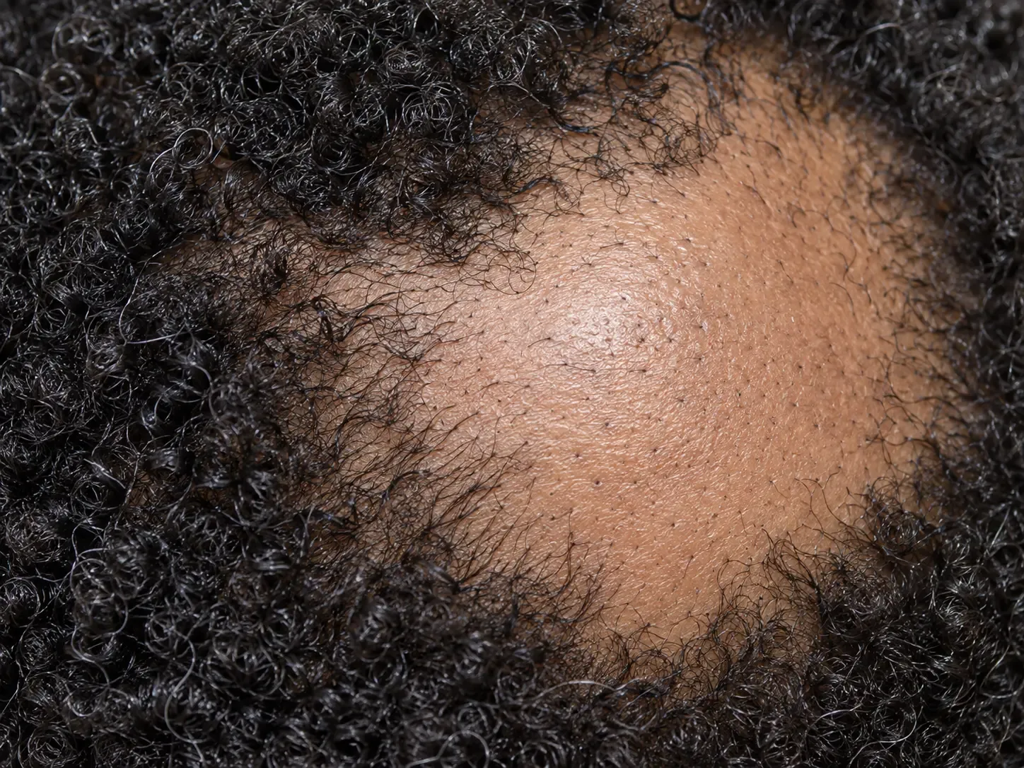 Round alopecia areata patch on the scalp with smooth skin and short fine hairs at the border