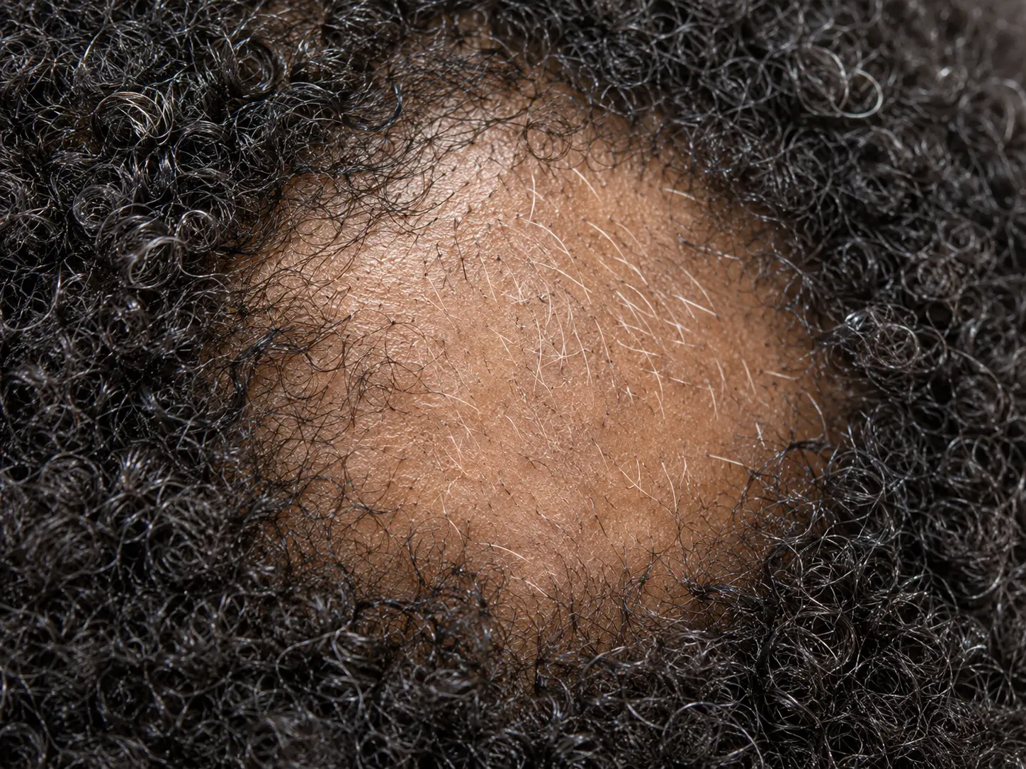 Fine unpigmented new hairs emerging within an alopecia areata patch as growth restarts