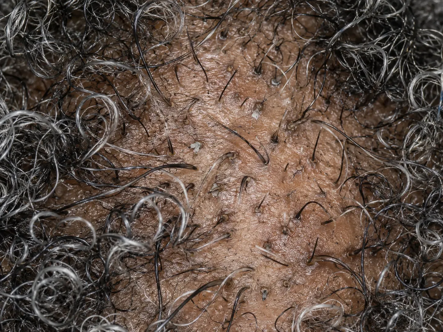 200x scalp view of anagen effluvium with broken, tapering hair shafts at different lengths across open follicle openings