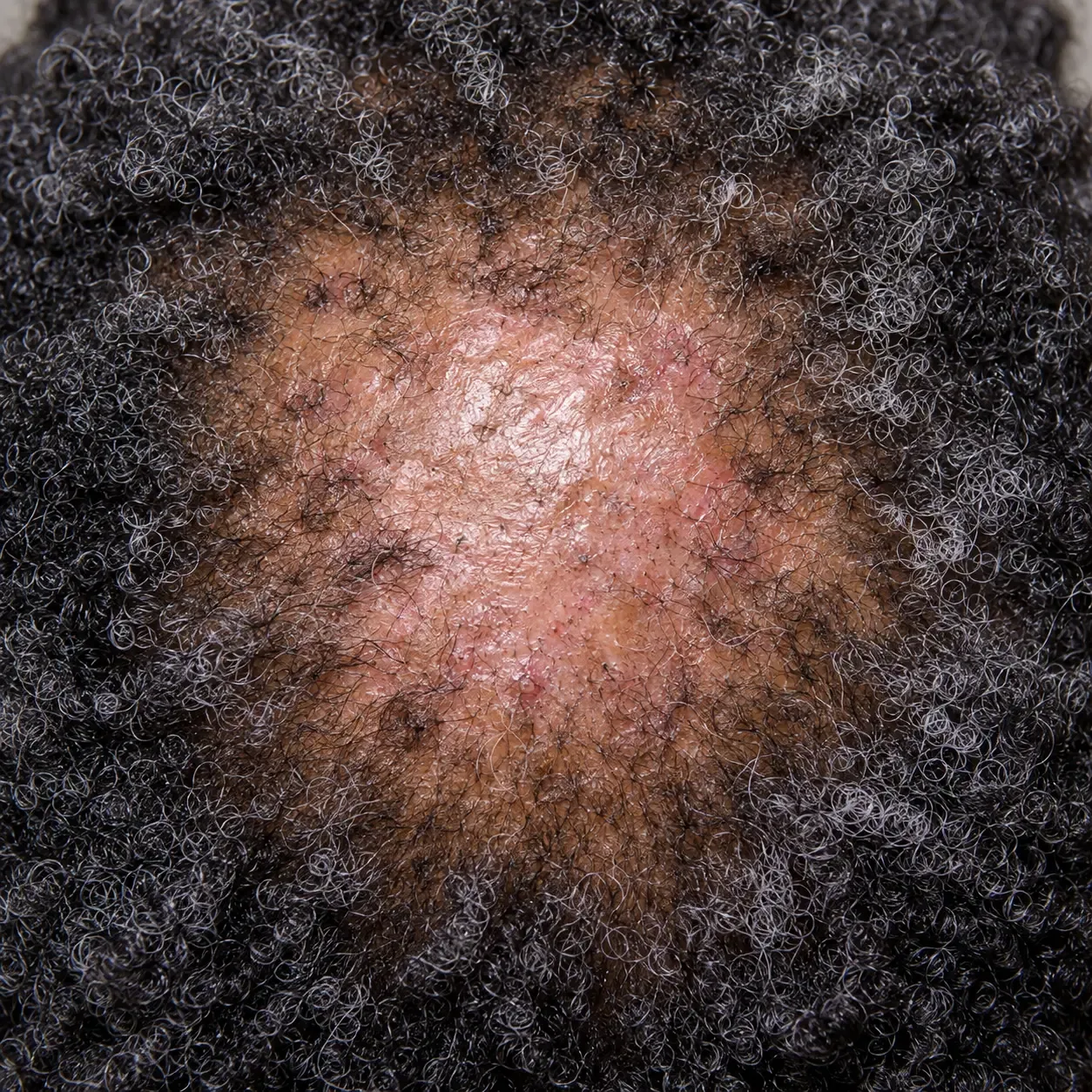 Close-up 200x scalp view of the active border of CCCA showing inflamed follicle openings with white halos and hairs still present before scarring